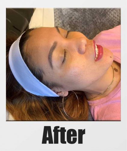JinkyJoyAfterPolaroid-e1570814764356 An After photo of Microneedling with PRP in Seattle, Bellevue, and Kirkland