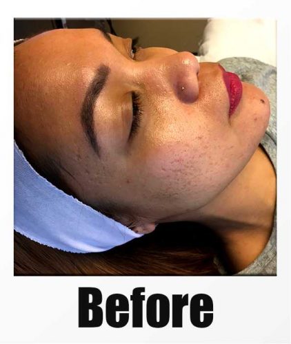 JinkyJoyBeforePolaroid-e1570814746163 Before picture of Microneedling with PRP in Seattle, Bellevue, and Kirkland