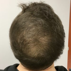 An After image of PRP Hair Restoration in Seattle, Bellevue, and Tacoma