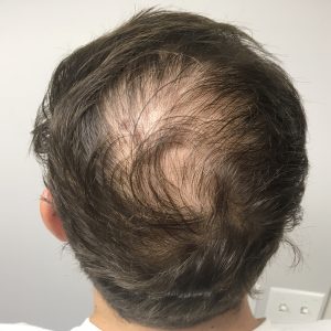 A Before photo of PRP Hair Restoration in Seattle, Bellevue, and Kirkland