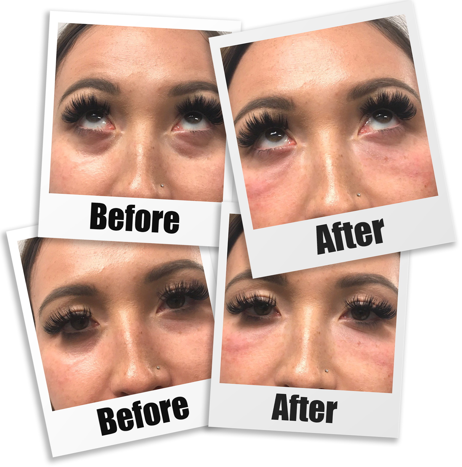 Before and After photos of PRP For Tear Trough Injections in Seattle, Bellevue, and Kirkland