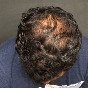 A Before photo of PRP With ACell Hair Restoration by Dr. Javad Sajan in Seattle, Bellevue, and Kirkland