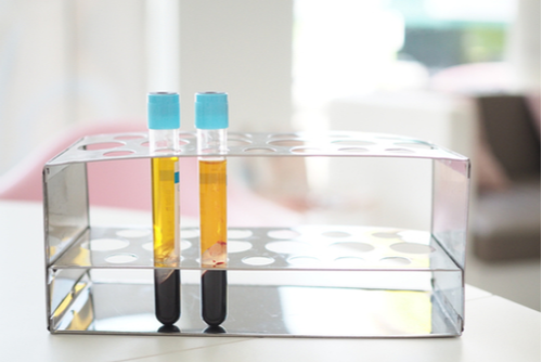 A Photo For A Blog Post About What Is Platelet Poor Plasma