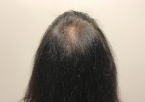 An After Photo of PRP With ACell Hair Restoration In Seattle, Bellevue, and Kirkland