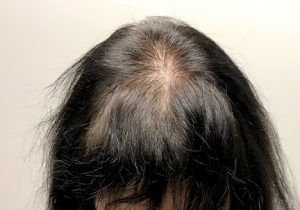 An After Photo Of PRP with ACell Hair Restoration In Seattle, Bellevue, and Kirkland