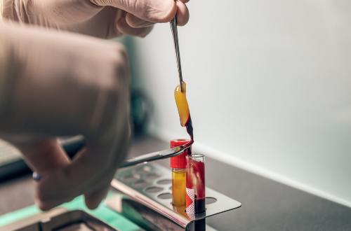 A Photo For A Blog About What Is Platelet Rich Fibrin