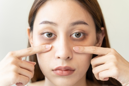 A Photo For A Blog Post About How Many PRP Treatments Do I Need For Under Eyes