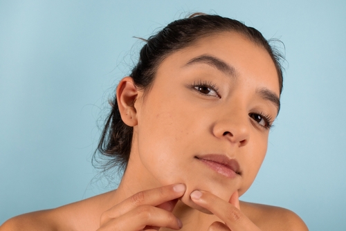 A Photo For Blog Post About PRP Microneedling vs. PRP Injections For Acne Scars