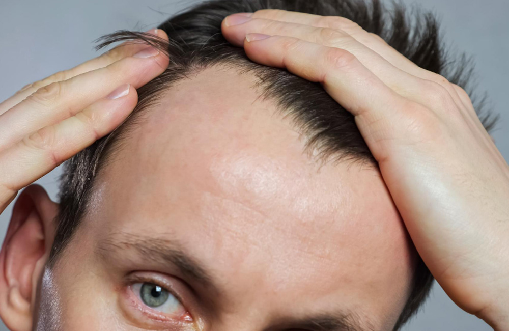 PRP After a Hair Transplant