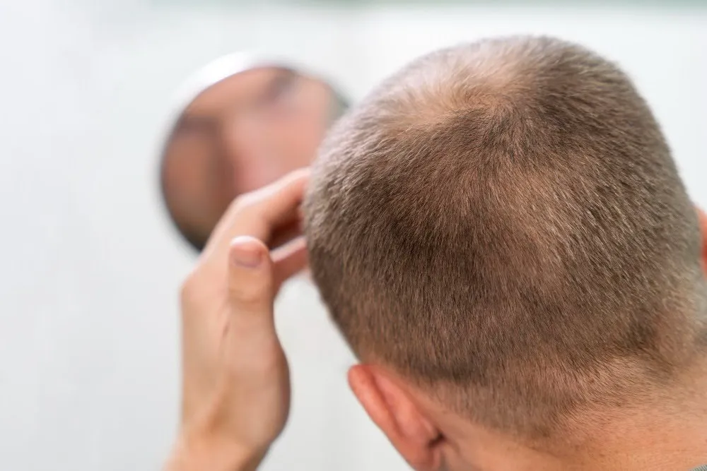 Who are the Good Candidates for Non-Surgical Hair Loss Treatment in Seattle?