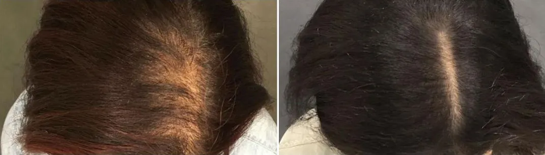 Who Is a Good Candidate for PRP for Thinning Hair?