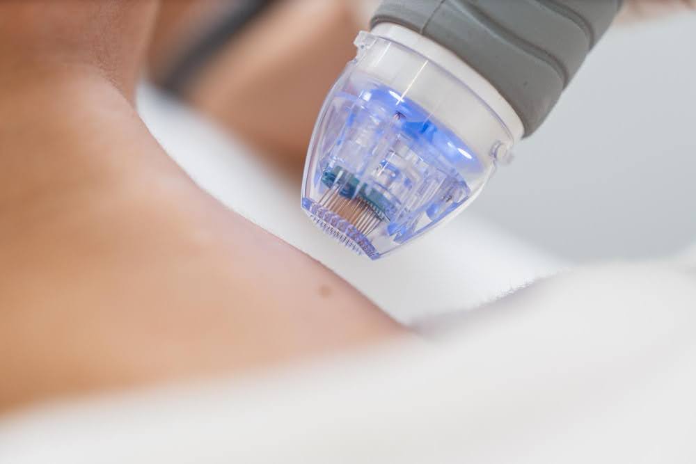 Can RF Microneedling With PRP Tighten Skin in Seattle?