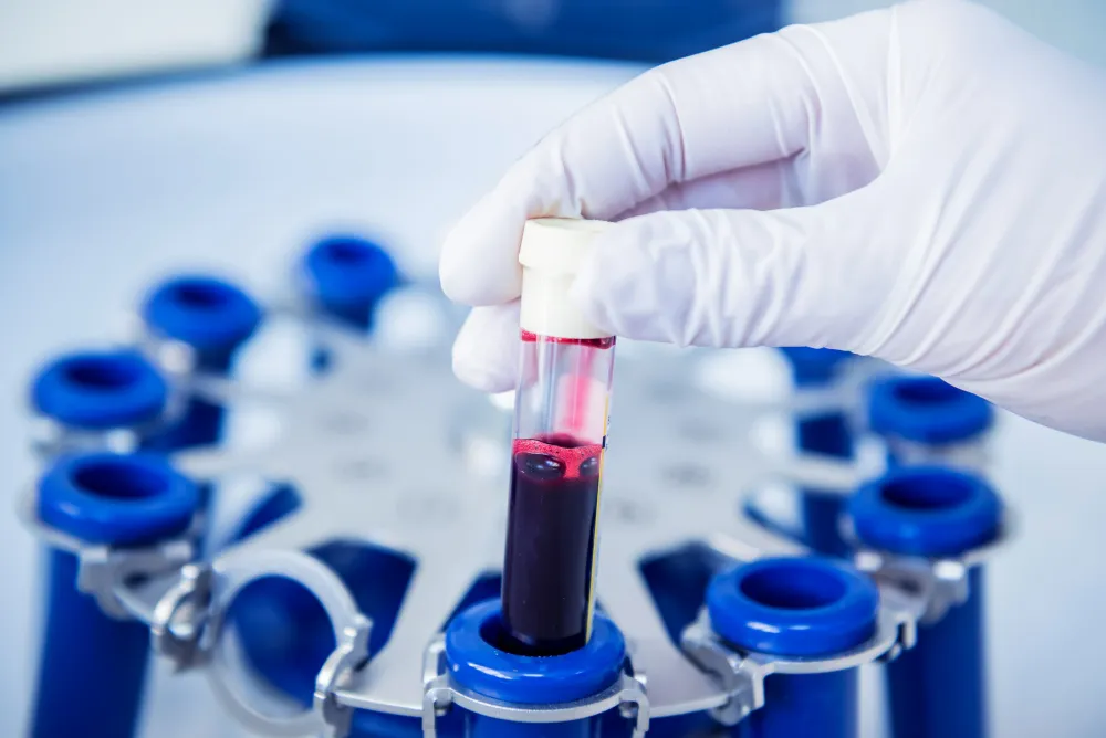 How PRP Works for Thinning Hair