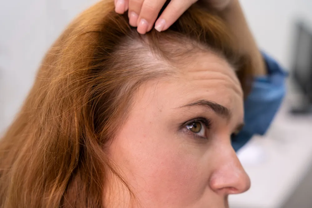 What Is Hair Thinning?