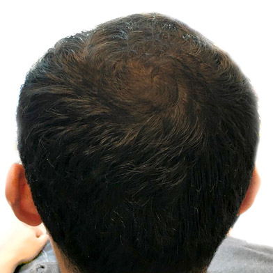 PRP Hair Restoration Case #3