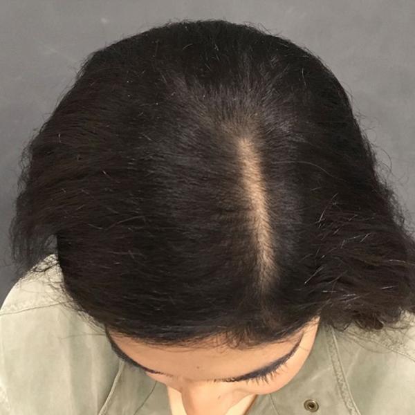 PRP With ACell Case #3