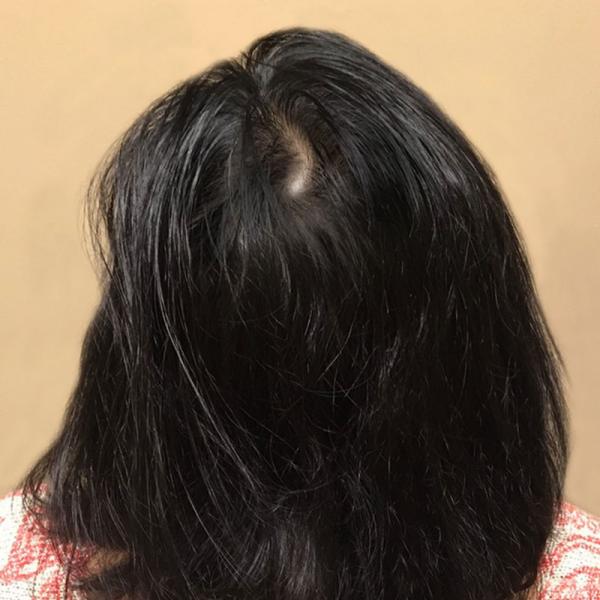 PRP With ACell Case #4