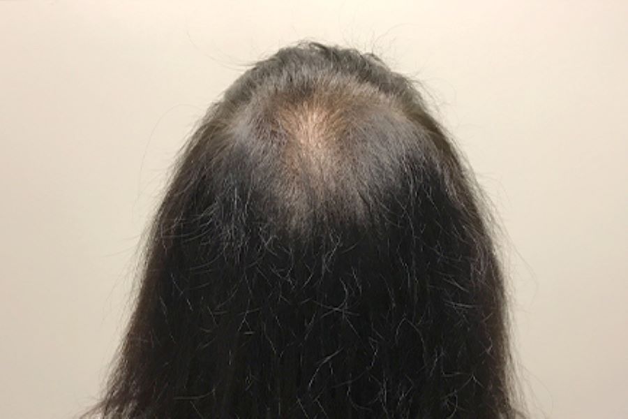 PRP With ACell Case #9