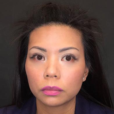 PRP Hair Restoration Case #2